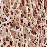 Bone-Marrow-25-thumb