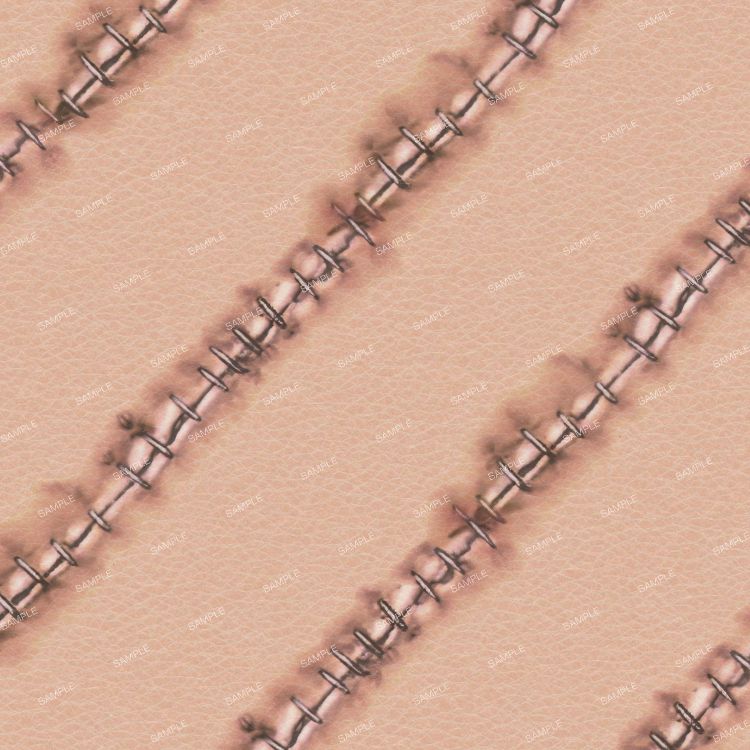 Stitches Sutures
